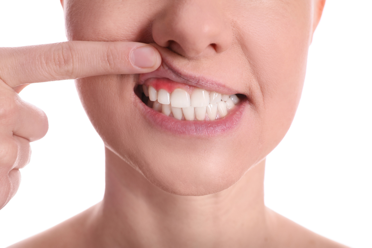 The image shows a closeup of a woman's teeth and gums affected by periodontal disease. The intention is to show how to protect against periodontal disease.