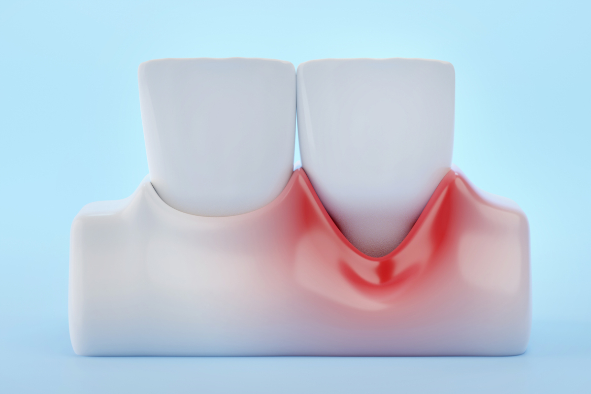 concept of gum recession