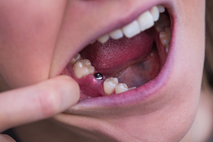 Featured image for What To Do If a Dental Implant Fails